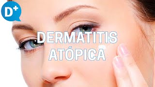 Diagnóstico y tratamiento de la dermatitis atópica [upl. by Schluter]