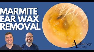 MARMITE EAR WAX REMOVAL EP879 [upl. by Dirraj]