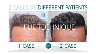 Hair Transplant 2 cases  Dr Rafael de Freitas [upl. by Nyladnek360]