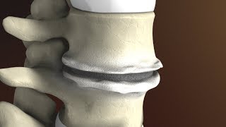 Degenerative Disc Disease Spondylosis explained by Spine Surgeon Dr Jessica Shellock Plano TX [upl. by Romaine903]