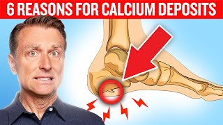 6 Reasons for Calcium Deposits Spurs Osteophytes Stones and Tartar [upl. by Airual204]