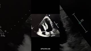 What would you do 😯 echocardiogram echocardiography cardiology [upl. by Sirtimid]