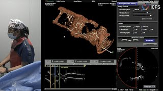 Left main and complex bifurcation stenting  EuroPCR 2024 [upl. by Ominoreg558]