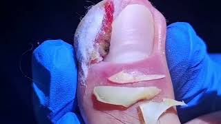 Removing Severely Infected Ingrown Toenails Patient Feels Relief After the Surgery [upl. by Ztnaj325]