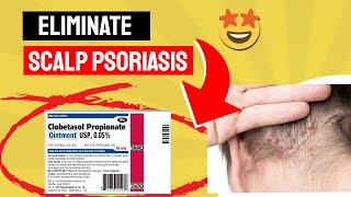 Say Goodbye to Scalp Psoriasis with Clobetasol Propionate A GameChanger [upl. by Giardap619]