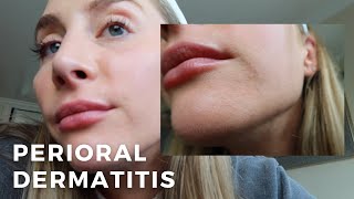 Perioral Dermatitis What to Know Skincare  An Estheticians Experience [upl. by Dambro996]