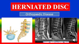 HERNIATED DISC  Definition types causes pathophysiology signs amp symptoms medicine [upl. by Ayenat365]