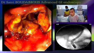 ERCP FOR ACUTE CHOLANGITIS [upl. by Macmullin]