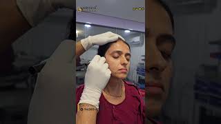 PICO Laser technology picolaser laser skincare pigmentation beauty pico fillers botox yt [upl. by Padget548]