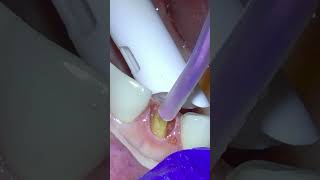 Repairing a Broken Tooth With A Subgingival Crown Procedure [upl. by Chapland615]