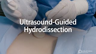 UltrasoundGuided Hydrodissection [upl. by Ennairrek557]