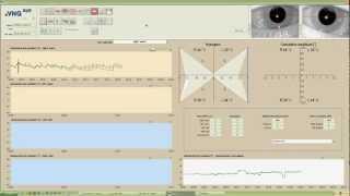 eVNG Caloric Test Demo [upl. by Kania177]