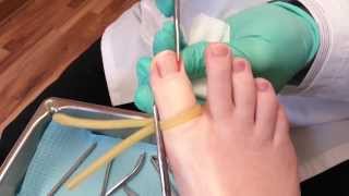 Ingrown toenail surgery [upl. by Filemon156]