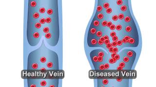 Healthy vs Diseased Vein [upl. by Krystle]