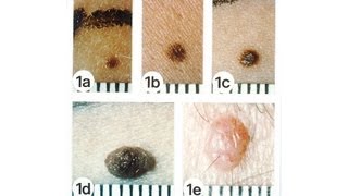 Skin Cancer amp Raised or Elevated Moles  Skin Cancer [upl. by Navac]