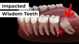 Impacted Wisdom Tooth Removal [upl. by Hubert]