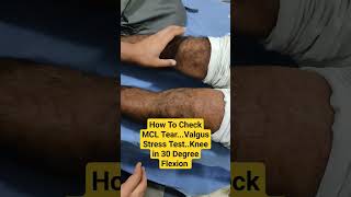 How To Check MCL TearValgus Stress TestKnee in 30 Degree Flexion Dr Sai Chandra [upl. by Charron]