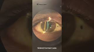 Contact Lens Fitting in Keratoconus  RGP Lenses  Rose K2 Lenses  Scleral Lenses  Hyderabad [upl. by Ennaitsirk]