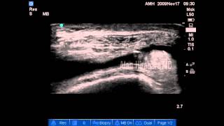 Ultrasound guided injection  Knee joint PRP [upl. by Dickman]