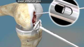 Arthrosurface UniCAP animation full technique [upl. by Atima]