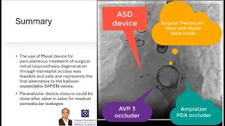 When Mitral Valve in Valve is not enough for Severe Mitral Regurgitation VIV PVL amp ASD closure [upl. by Giraldo]