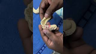 1 unit Pfm crown super ceramic dental labdentallaboratoryviralvideo🥀🥀🥀🥀🥀🥀🥀 [upl. by Arette]