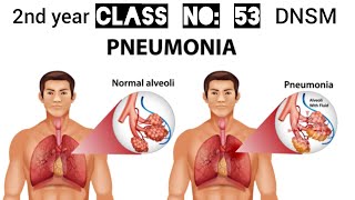 Pneumonia  Defination  Causes  Clinical Features  Medical  Nursing Management  Complications [upl. by Beatrisa]