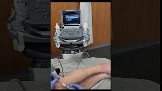 Iliotibial band syndrome ITBS and local injection under ultrasound guidance [upl. by Donald30]