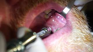 Inferior Alveolar IA Injection [upl. by Seyler]