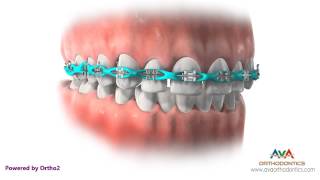 Space Closure by Power Chain  Orthodontic Treatment [upl. by Husch748]