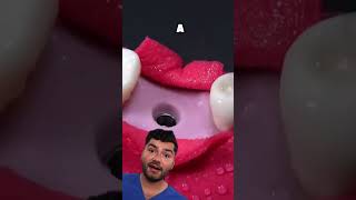 Dental Implant Explained [upl. by Mulac522]