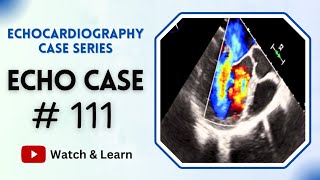 Echocardiography Case 111  Echocardiogram Interpretation Made Easy  TOACS [upl. by Lightfoot]