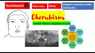 Cherubism DETAILED  fibroosseous lesions  Oral pathology  NEET MDSBDS with Diagrams Shafers [upl. by Sofko]