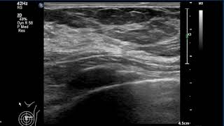 Breast Ultrasound  normal anatomy [upl. by Kcolttam]