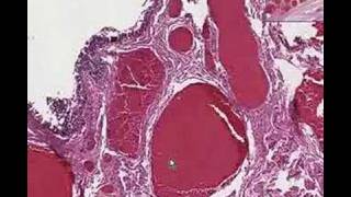 Histopathology Anus Hemorrhoids [upl. by Bradshaw]