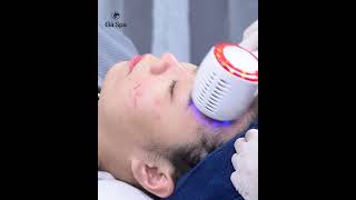 Acne Treatment for Inflamed Stomach [upl. by Duquette237]