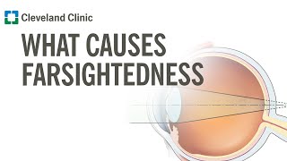 What Causes Farsightedness [upl. by Amero106]