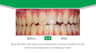 Opalescence Go  Take Home Teeth Whitening [upl. by Roderic]