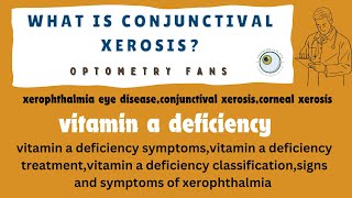 vitamin a deficiency  xerophthalmia eye disease  conjunctival xerosis  corneal xerosis [upl. by Seravat871]