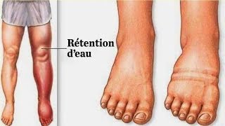 Rétention d’eau  en voici la cause et comment dégonfler les pieds et les jambes naturellement [upl. by Eileek]