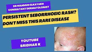 Persistent seborrhoeic rashdont miss Letterer Siwe disease rash newbornrash dermatology [upl. by Letti]