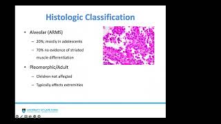 Surgical considerations for Rhabdomyosarcoma in children Dr Charles Moyo [upl. by Isola]