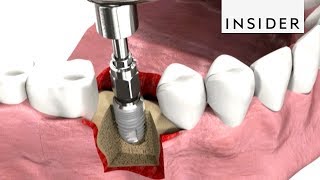 How Dentists Insert Dental Implants [upl. by Llaccm]