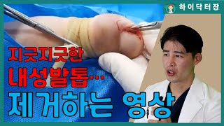 당신의 내성발톱이 잘 낫지 않는이유feat 내성발톱근본치료 [upl. by Lustig]