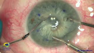 DMEK  endoin pullthrough technique No OVD during the procedure [upl. by Milburn]