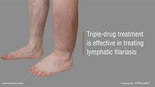 Tripledrug treatment is effective in treating lymphatic filariasis [upl. by Cully]