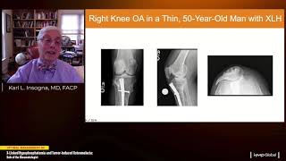 Optimal Management of XLinked Hypophosphatemia and TumorInduced Osteomalacia [upl. by Androw]