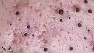 Blackhead Whitehead Removal  Cystic Acne Treatment  Facial Pimple Popping  Elderly Acne Spa 084 [upl. by Suoicserp]