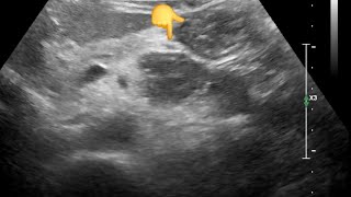 Diagnostic dilemma Pancreatic Lesion Jejunal Loop Mimicking Cancer on Ultrasound – CT Clarifies [upl. by Eceryt]