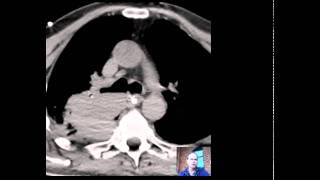 CT Lung Mass Brain Mets Discussed by Radiologist [upl. by Canute]